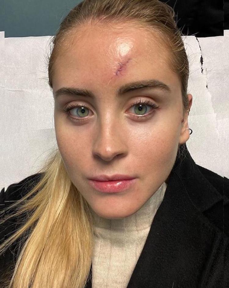 Valentina mostra la cicatrice dopo l'intervento e mette in guardia i fan